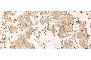 Immunohistochemistry of paraffin-embedded Human lung cancer tissue using TEX11 Polyclonal Antibody at dilution of 1:30(x200) (TEX11 抗体)