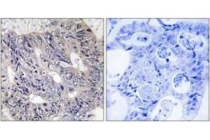 Immunohistochemistry analysis of paraffin-embedded human colon carcinoma tissue, using ES8L1 Antibody. (EPS8-Like 1 抗体  (AA 411-460))