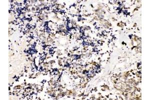 IHC testing of FFPE human lung cancer tissue with TRF2 antibody at 1ug/ml. (TRF2 抗体)
