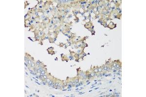 Immunohistochemistry of paraffin-embedded human prostate using NEDD4L antibody (ABIN6132407, ABIN6144504, ABIN6144505 and ABIN6224109) at dilution of 1:200 (40x lens).