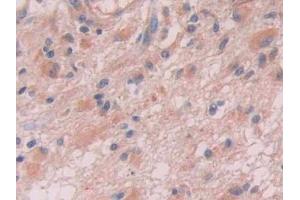 IHC-P analysis of Human Glioma Tissue, with DAB staining.