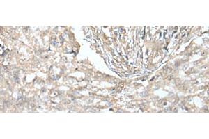 Immunohistochemistry of paraffin-embedded Human lung cancer tissue using VILL Polyclonal Antibody at dilution of 1:65(x200) (VILL 抗体)