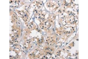 Immunohistochemical analysis of paraffin-embedded Human thyroid cancer tissue using at dilution 1/25. (CTAG1A 抗体  (Internal Region))
