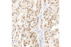 Immunohistochemistry of paraffin-embedded human colon carcinoma using SOCS1 Rabbit mAb (ABIN7270640) at dilution of 1:100 (40x lens). (SOCS1 抗体)
