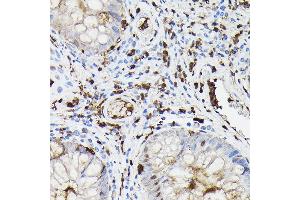 Immunohistochemistry of paraffin-embedded human colon carcinoma using Gelsolin Rabbit pAb (ABIN7267365) at dilution of 1:50 (40x lens). (Gelsolin 抗体  (AA 543-782))