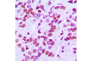 Immunohistochemical analysis of CANP staining in human breast cancer formalin fixed paraffin embedded tissue section.