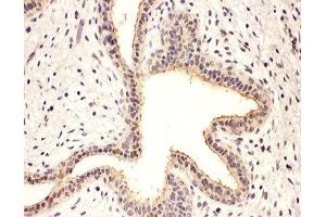 IHC-P: Rab8 antibody testing of human breast cancer tissue (RAB8A 抗体  (C-Term))