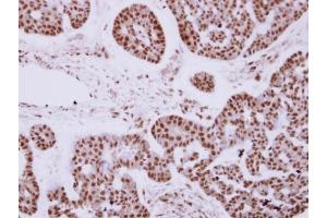 IHC-P Image Immunohistochemical analysis of paraffin-embedded human breast cancer, using ZNF148 antibody [N1N2], N-term, antibody at 1:250 dilution. (ZNF148 抗体  (N-Term))