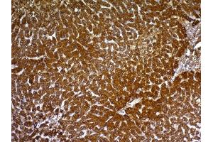 Formalin-fixed, paraffin-embedded human Hepatocellular Carcinoma stained with HepPar-1 Mouse Monoclonal Antibody (HepPar1). (Hepatocyte Specific Antigen 抗体)