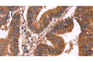 Immunohistochemistry of paraffin-embedded Human colon cancer using ERP29 Polyclonal Antibody at dilution of 1:40 (ERP29 抗体)