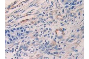 Detection of ENA78 in Human Colorectal cancer Tissue using Polyclonal Antibody to Epithelial Neutrophil Activating Peptide 78 (ENA78) (CXCL5 抗体  (AA 38-114))