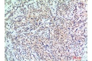 Immunohistochemistry (IHC) analysis of paraffin-embedded Human Breast Cancer, antibody was diluted at 1:200. (p300 抗体)