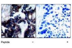 Immunohistochemical analysis of paraffin-embedded human breast carcinoma tissue, using RPS6KB1 (phospho S424) polyclonal antibody . (RPS6KB1 抗体  (pSer424))
