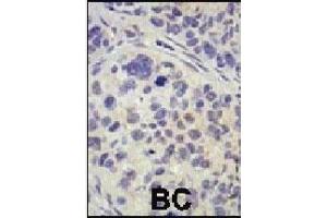 Formalin-fixed and paraffin-embedded human cancer tissue reacted with the primary antibody, which was peroxidase-conjugated to the secondary antibody, followed by AEC staining. (USP8 抗体  (C-Term))