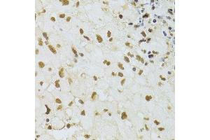 Immunohistochemistry of paraffin-embedded human brain cancer using DDB1 Antibody. (DDB1 抗体)