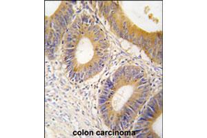 Formalin-fixed and paraffin-embedded human colon carcinoma tissue reacted with ALDOC polyclonal antibody  , which was peroxidase-conjugated to the secondary antibody, followed by DAB staining. (ALDOC 抗体  (C-Term))