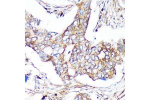 Immunohistochemistry of paraffin-embedded Human colon carcinoma using C Rabbit pAb (ABIN7266547) at dilution of 1:100 (40x lens). (CAND2 抗体  (AA 850-1000))