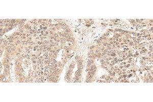 Immunohistochemistry of paraffin-embedded Human liver cancer tissue using EXOSC9 Polyclonal Antibody at dilution of 1:35(x200) (EXOSC9 抗体)