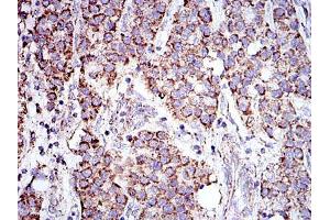Immunohistochemical analysis of paraffin-embedded liver cancer tissues using PHB mouse mAb with DAB staining.