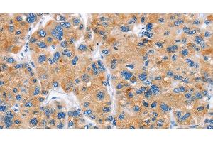 Immunohistochemistry of paraffin-embedded Human liver cancer tissue using DKK2 Polyclonal Antibody at dilution 1:60 (DKK2 抗体)