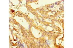 Immunohistochemistry of paraffin-embedded human colon cancer using ABIN7158821 at dilution of 1:100 (LYG2 抗体  (AA 20-212))