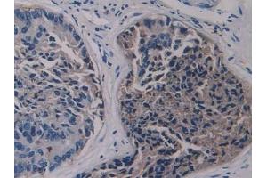 Detection of LSR in Human Prostate cancer Tissue using Polyclonal Antibody to Lipolysis Stimulated Lipoprotein Receptor (LSR) (LSR 抗体  (AA 335-589))