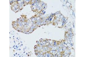 Immunohistochemistry of paraffin-embedded Human rectal cancer using EGFR Polyclonal Antibody at dilution of 1:100 (40x lens).