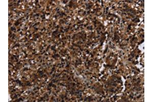 The image on the left is immunohistochemistry of paraffin-embedded Human liver cancer tissue using ABIN7191356(MAGEE1 Antibody) at dilution 1/30, on the right is treated with synthetic peptide. (MAGEE1 抗体)