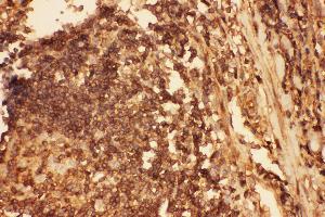 Anti-Cofilin Picoband antibody,  IHC(P): Human Intestinal Cancer Tissue (Cofilin 抗体  (AA 2-166))