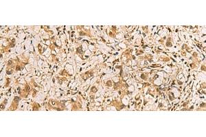 Immunohistochemistry of paraffin-embedded Human liver cancer tissue using PDXK Polyclonal Antibody at dilution of 1:75(x200) (PDXK 抗体)