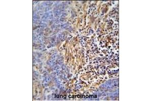 HLA-DRB5 Antibody (Center) (ABIN653782 and ABIN2843069) immunohistochemistry analysis in formalin fixed and paraffin embedded human lung carcinoma followed by peroxidase conjugation of the secondary antibody and DAB staining. (HLA-DRB5 抗体  (AA 43-70))