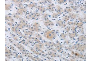 The image on the left is immunohistochemistry of paraffin-embedded Human liver cancer tissue using ABIN7190267(CKMT1A/CKMT1B Antibody) at dilution 1/80, on the right is treated with synthetic peptide. (CKMT1A 抗体)