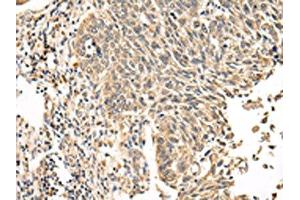 The image on the left is immunohistochemistry of paraffin-embedded Human lung cancer tissue using ABIN7131591(VPS53 Antibody) at dilution 1/20, on the right is treated with fusion protein. (VPS53 抗体)