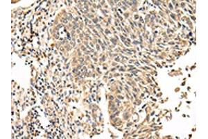 The image on the left is immunohistochemistry of paraffin-embedded Human lung cancer tissue using ABIN7131591(VPS53 Antibody) at dilution 1/20, on the right is treated with fusion protein.