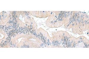 Immunohistochemistry of paraffin-embedded Human colorectal cancer tissue using UBE2F Polyclonal Antibody at dilution of 1:70(x200) (UBE2F 抗体)
