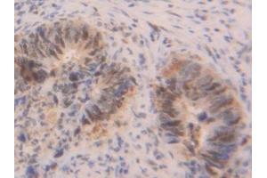 Detection of PCNA in Human Colorectal cancer Tissue using Polyclonal Antibody to Proliferating Cell Nuclear Antigen (PCNA) (PCNA 抗体  (AA 6-261))