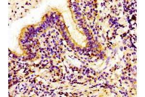 Immunohistochemistry of paraffin-embedded human lung cancer using ABIN7157016 at dilution of 1:100 (Involucrin 抗体  (AA 24-118))