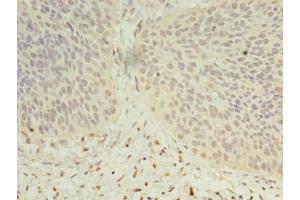 Immunohistochemistry of paraffin-embedded human cervical cancer using ABIN7149610 at dilution of 1:100