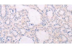Immunohistochemistry of paraffin-embedded Human thyroid cancer tissue using TSHR Polyclonal Antibody at dilution 1:50 (TSH receptor 抗体)