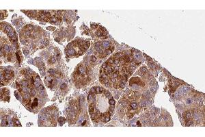 ABIN6277326 at 1/100 staining Human liver cancer tissue by IHC-P. (GNA11 抗体  (Internal Region))