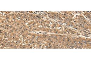 Immunohistochemistry of paraffin-embedded Human liver cancer tissue using CBLN3 Polyclonal Antibody at dilution of 1:25(x200) (CBLN3 抗体)