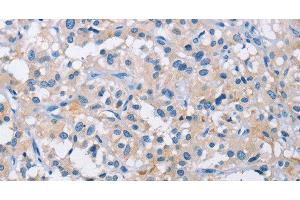 Immunohistochemistry of paraffin-embedded Human thyroid cancer tissue using ATP6AP2 Polyclonal Antibody at dilution 1:50 (ATP6AP2 抗体)