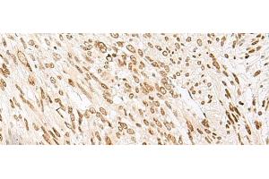 Immunohistochemistry of paraffin-embedded Human liver cancer tissue using NHP2 Polyclonal Antibody at dilution of 1:55(x200) (NHP2 抗体)