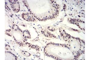 Immunohistochemical analysis of paraffin-embedded colon cancer tissues using HIST2H3C(27Ac) mouse mAb with DAB staining. (Histone Cluster 2, H3c (HIST2H3C) (acLys27) 抗体)