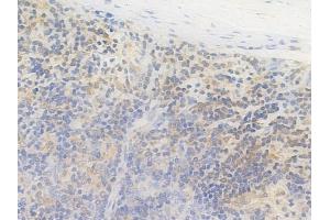 ABIN6264249 and ABIN6269096 at 1/100 staining human melanoma by IHC-P. (Pkc beta 1 抗体  (C-Term))