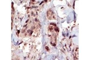IHC analysis of FFPE human breast carcinoma tissue stained with the SPHK2 antibody (SPHK2 抗体  (AA 590-620))