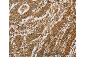 Immunohistochemistry of Human thyroid cancer using CYP39A1 Polyclonal Antibody at dilution of 1:50 (CYP39A1 抗体)