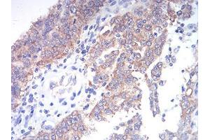 Immunohistochemical analysis of paraffin-embedded endometrial cancer tissues using TBCC mouse mAb with DAB staining. (TBCC 抗体  (AA 1-196))