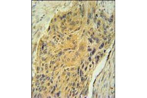 AVP Antibody immunohistochemistry analysis in formalin fixed and paraffin embedded human lung carcinoma followed by peroxidase conjugation of the secondary antibody and DAB staining. (Vasopressin 抗体  (AA 102-129))