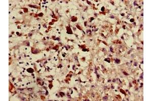 Immunohistochemistry of paraffin-embedded human melanoma using ABIN7144876 at dilution of 1:100